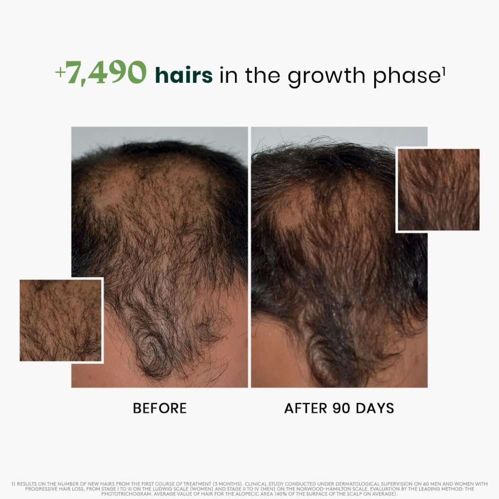 White Smoke Rene Furterer Triphasic Progressive Concentrated Serum for Hereditary, Hormonal Thinning Hair - Drug-Free - Receding Hairline - Leave-In - Sulfate, Paraben, Silicone-Free - 8 ct., 30-Day Supply
