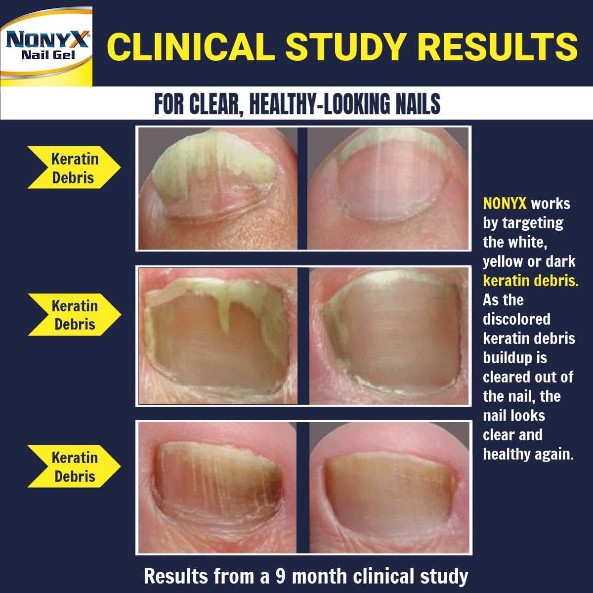 Midnight Blue NONYX Fungal Nail Clarifying Gel | Clinically Proven for Discolored, Thick, Brittle, Yellow, Lifted, and other signs of Fungus-Damaged Toenails | 90% of Nails Improve | Over 8 million sold