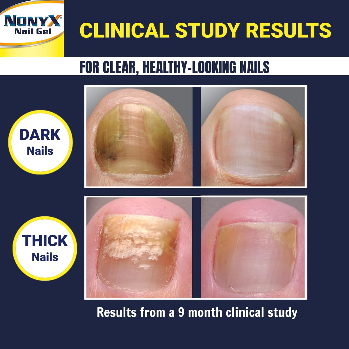 Midnight Blue NONYX Fungal Nail Clarifying Gel | Clinically Proven for Discolored, Thick, Brittle, Yellow, Lifted, and other signs of Fungus-Damaged Toenails | 90% of Nails Improve | Over 8 million sold