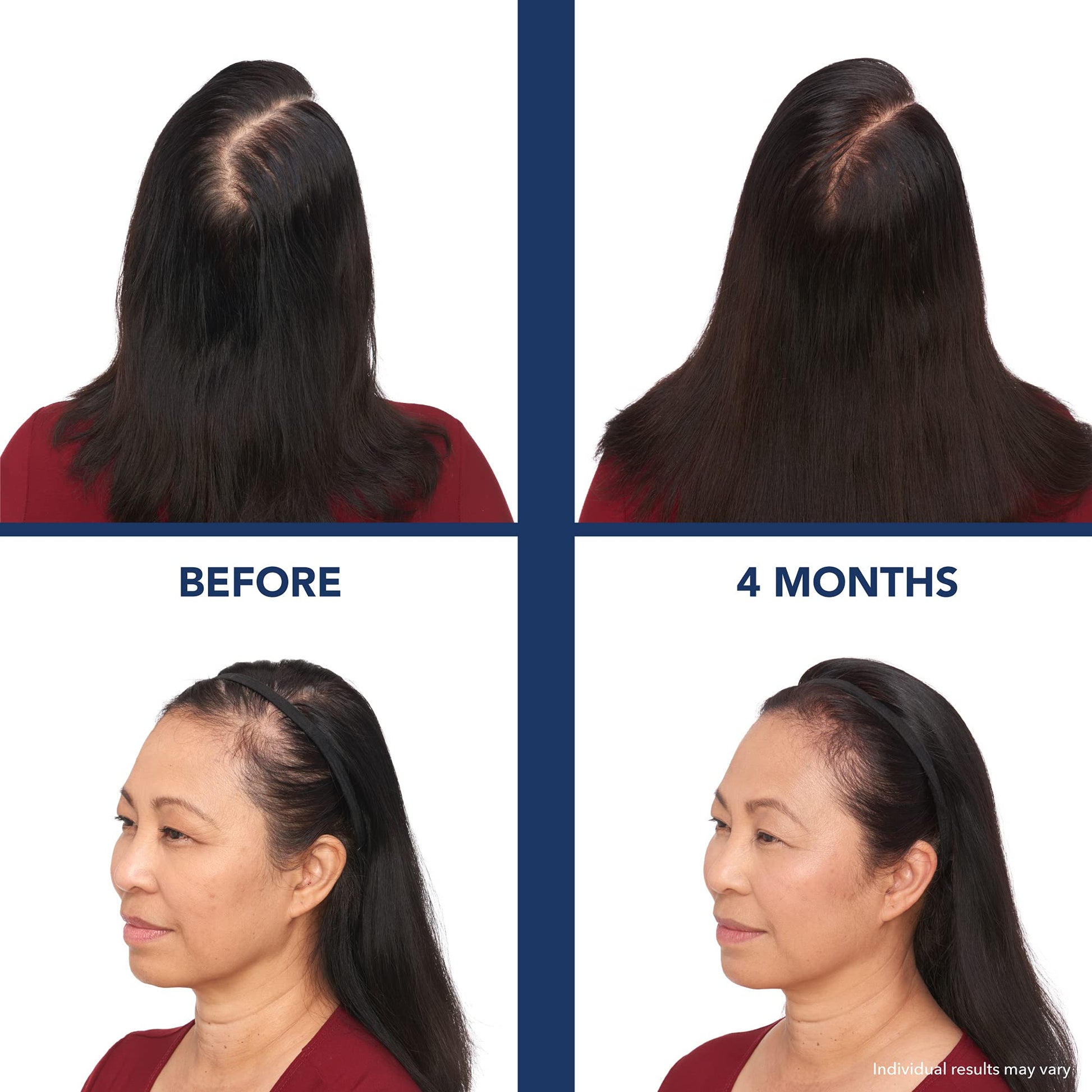 White Smoke Bosley Revitalizer 272 Flex 100% Laser No LEDs Hair Growth Cap (LLLT) Men and Women - Regrowth, Home Treatment, Thicker, Fuller, Healthy Hair, FDA Cleared, Large Size