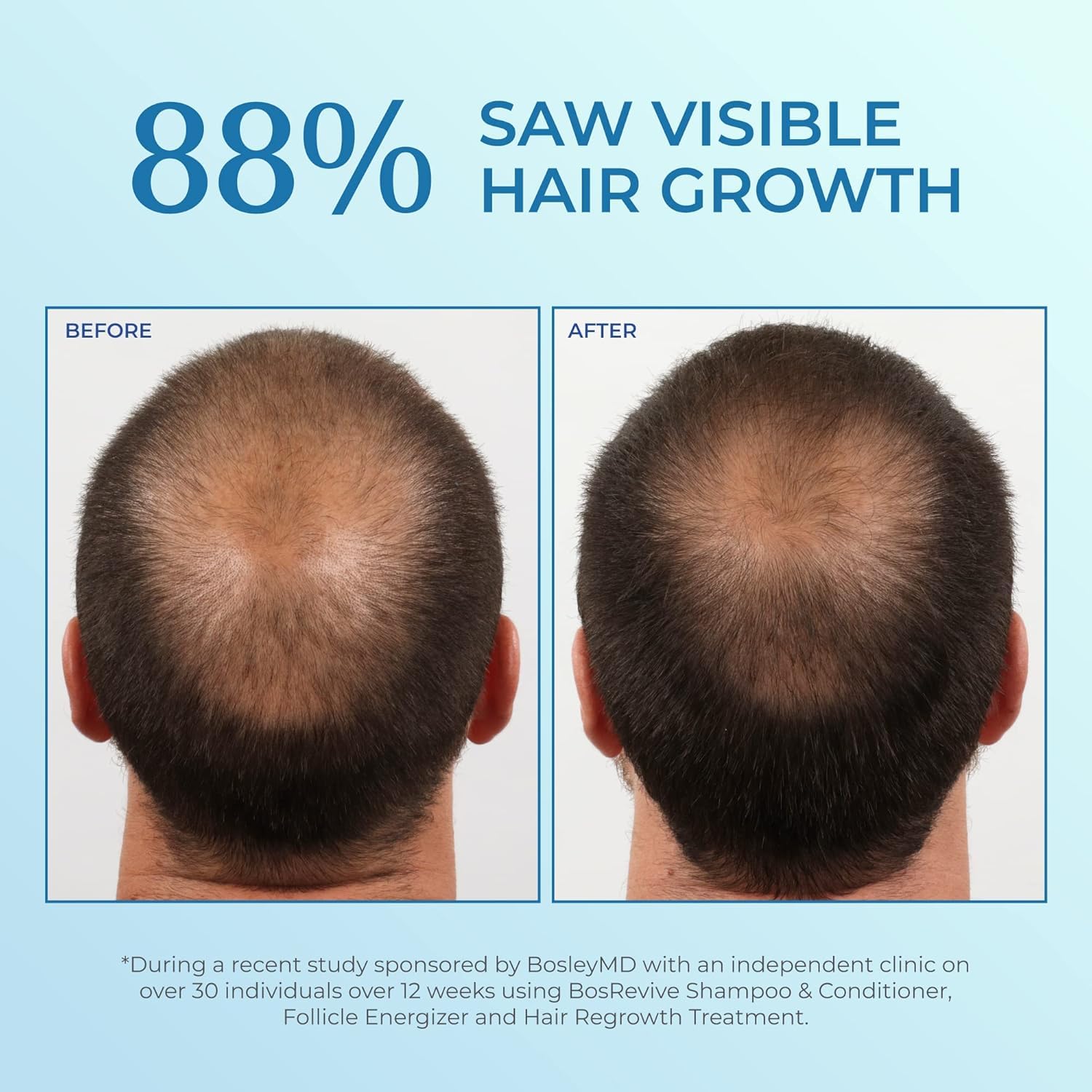 Light Cyan BosleyMD Minoxidil Foam, Extra Strength Thinning Treatment for Hair Loss and Hair Regrowth for Men, Women 5% Topical Solution, Foam/Mousse, 1-month supply, 2 oz.