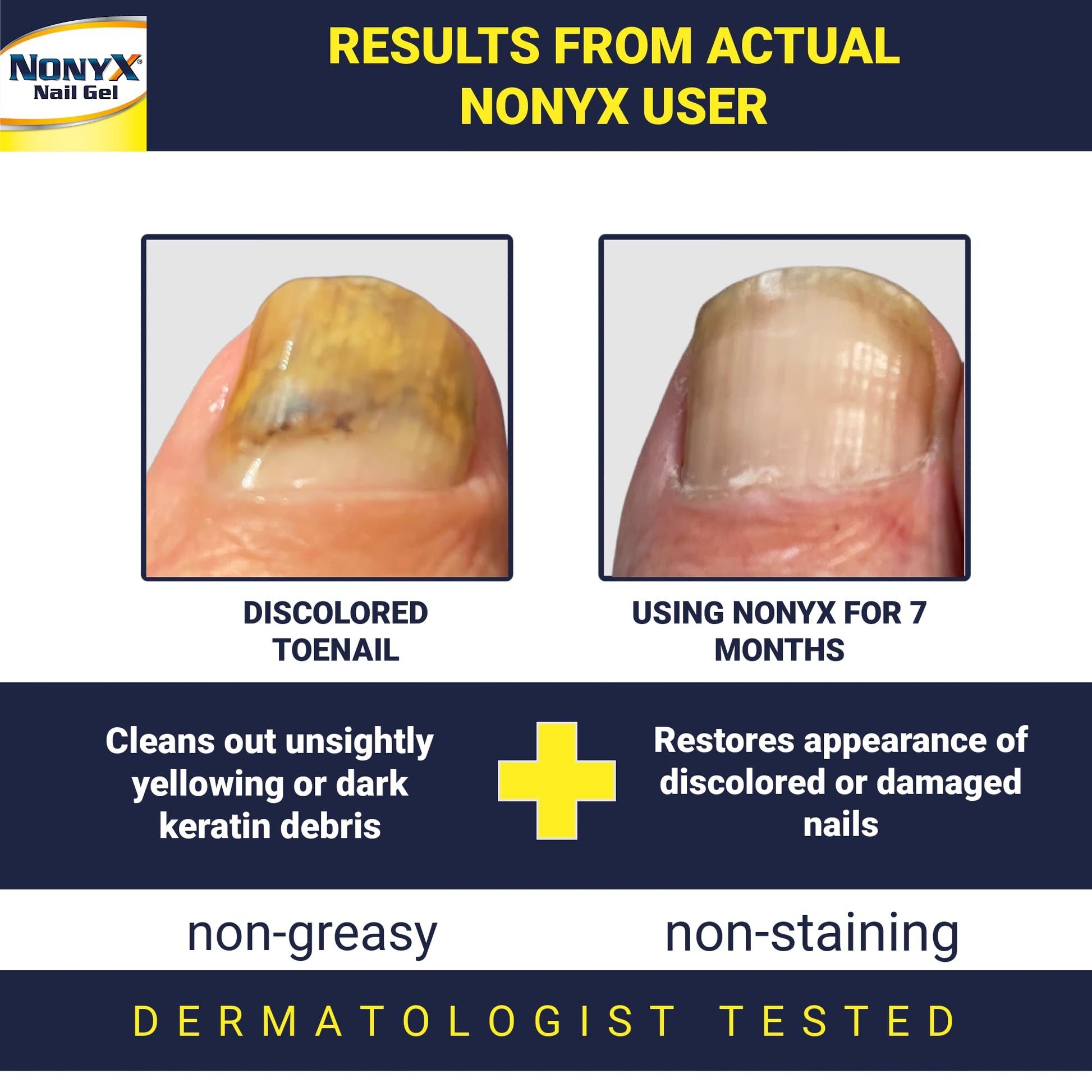 White Smoke NONYX Fungal Nail Clarifying Gel | Clinically Proven for Discolored, Thick, Brittle, Yellow, Lifted, and other signs of Fungus-Damaged Toenails | 90% of Nails Improve | Over 8 million sold