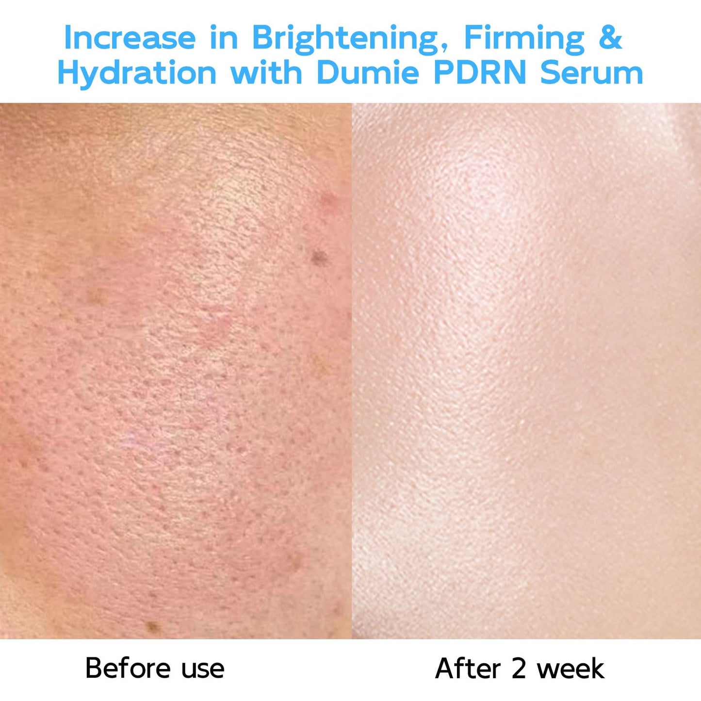 Wheat Salmon DNA PDRN Anti-Aging Serum, 5000ppm Salmon Egg DNA Ampoule, 2000ppm Collagen, Glutathione, Niacinamide & 6 Hyaluronic Acids, Korean Skincare for Wrinkles & Radiance,0.05 fl.oz x 30e