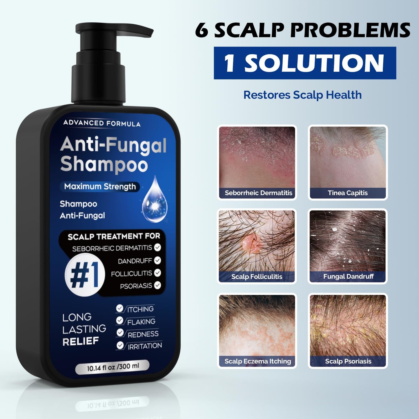 Alice Blue Antifungal Psoriasis Shampoo for Seborrheic Dermatitis, Folliculitis & Scalp Psoriasis, Anti-Dandruff Shampoo for Men & Women, Relieves Scalp Itching, Dryness, Sulfate & Paraben-Free, 10.1 Fl Oz-Fresh