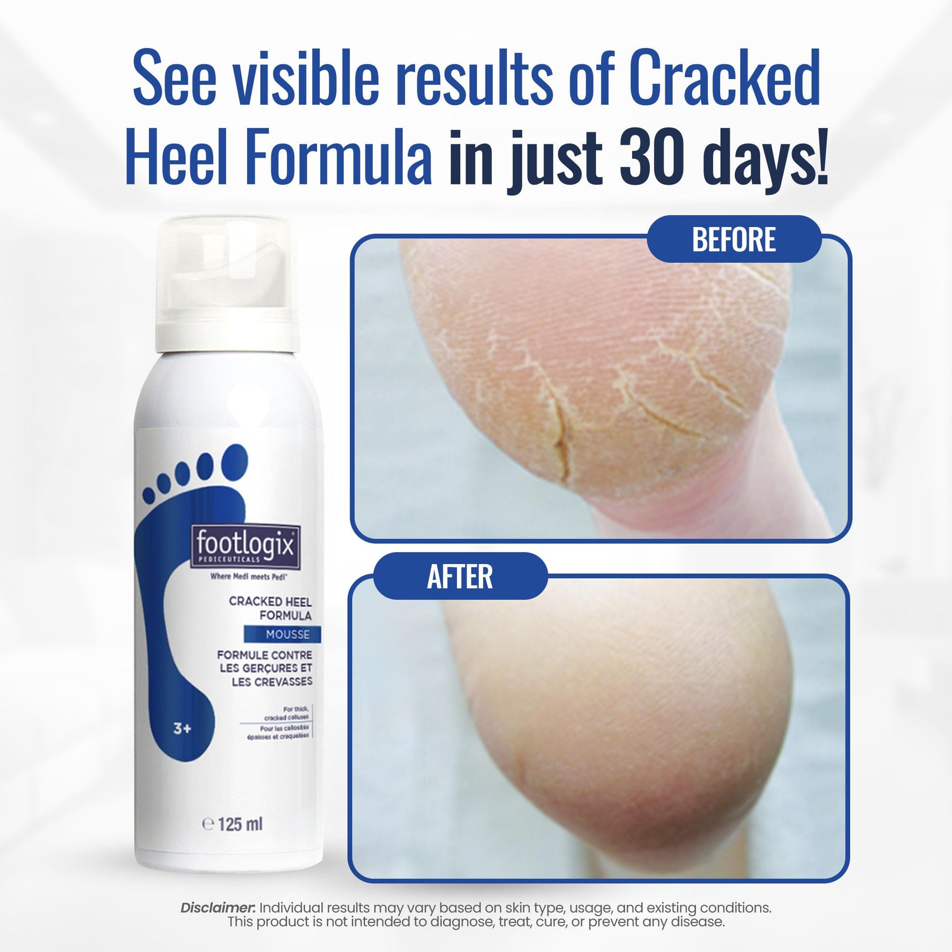 White Smoke FOOTLOGIX Cracked Heel Formula, White 4.23 Ounce