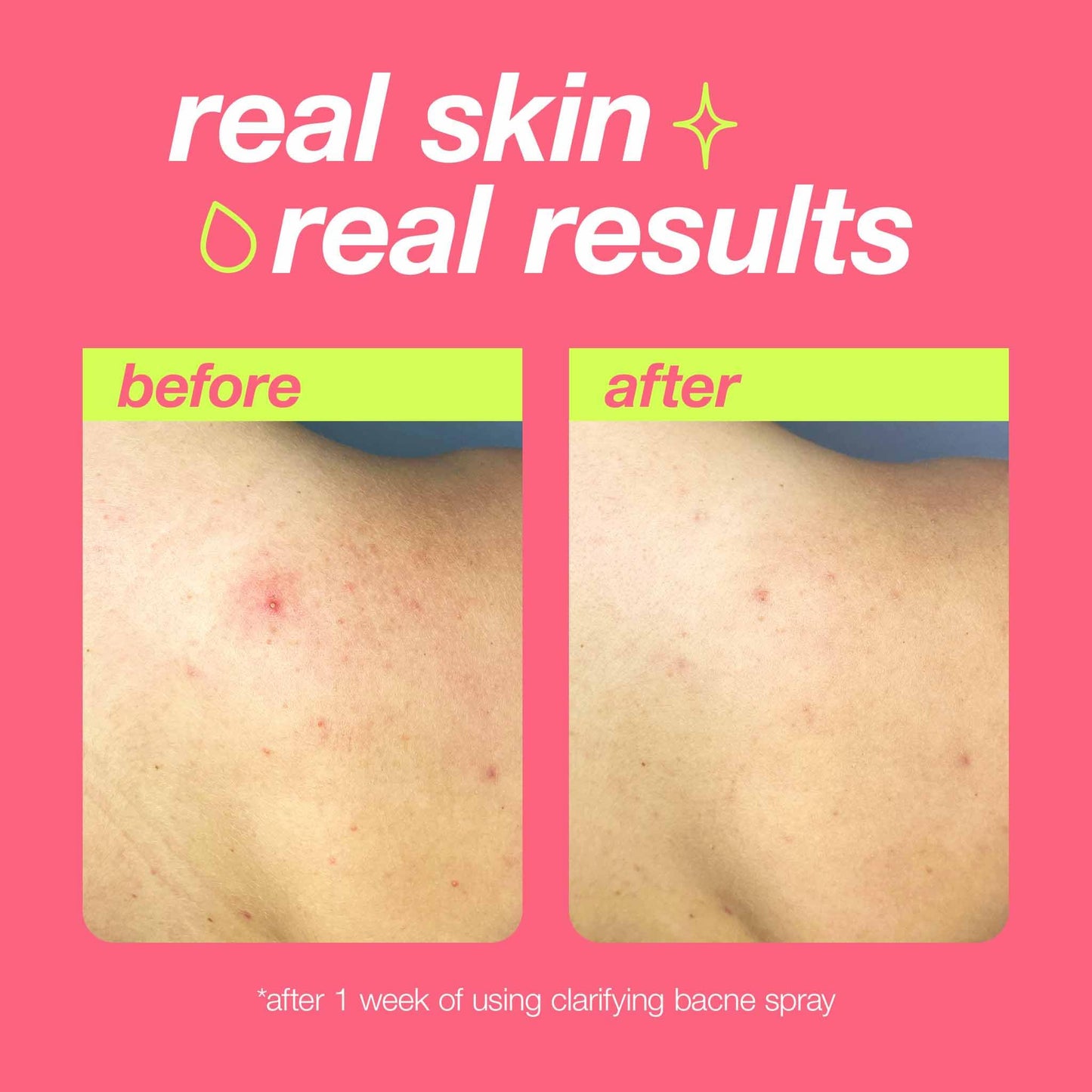 Light Coral Dermalogica Clear Start Clarifying Bacne Spray, Back Acne Treatment Spray for Body Breakout - Pore Clearing, Preventing Pimple with Salicylic Acid, Witch Hazel, Tea Tree Oil, All Skin Type, 6 fl oz