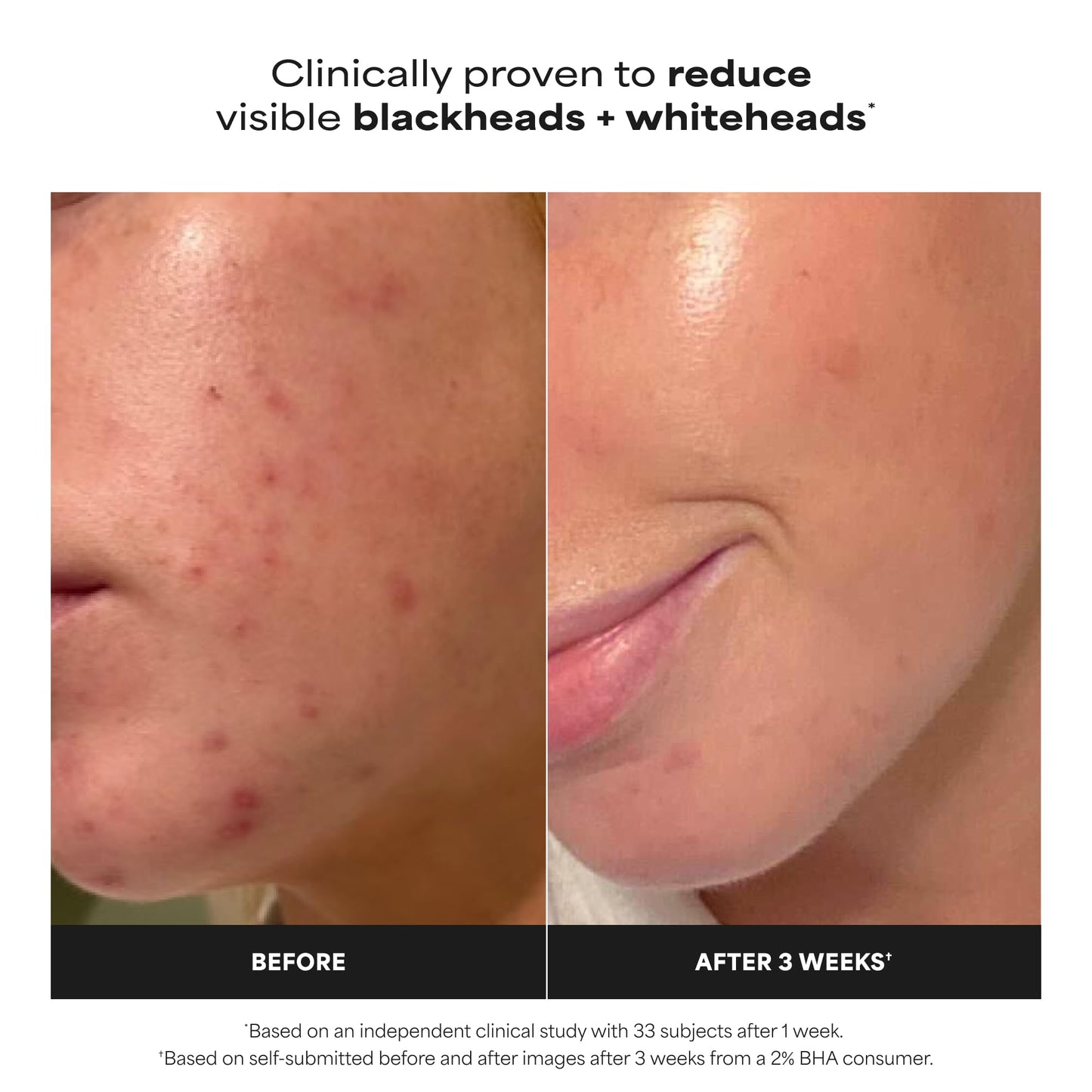 White Smoke Paula's Choice Skin Perfecting 2% BHA Liquid Salicylic Acid Exfoliant, Gentle Facial Exfoliator for Blackheads, Large Pores, Wrinkles & Fine Lines, Travel Size, 1 Fluid Ounce