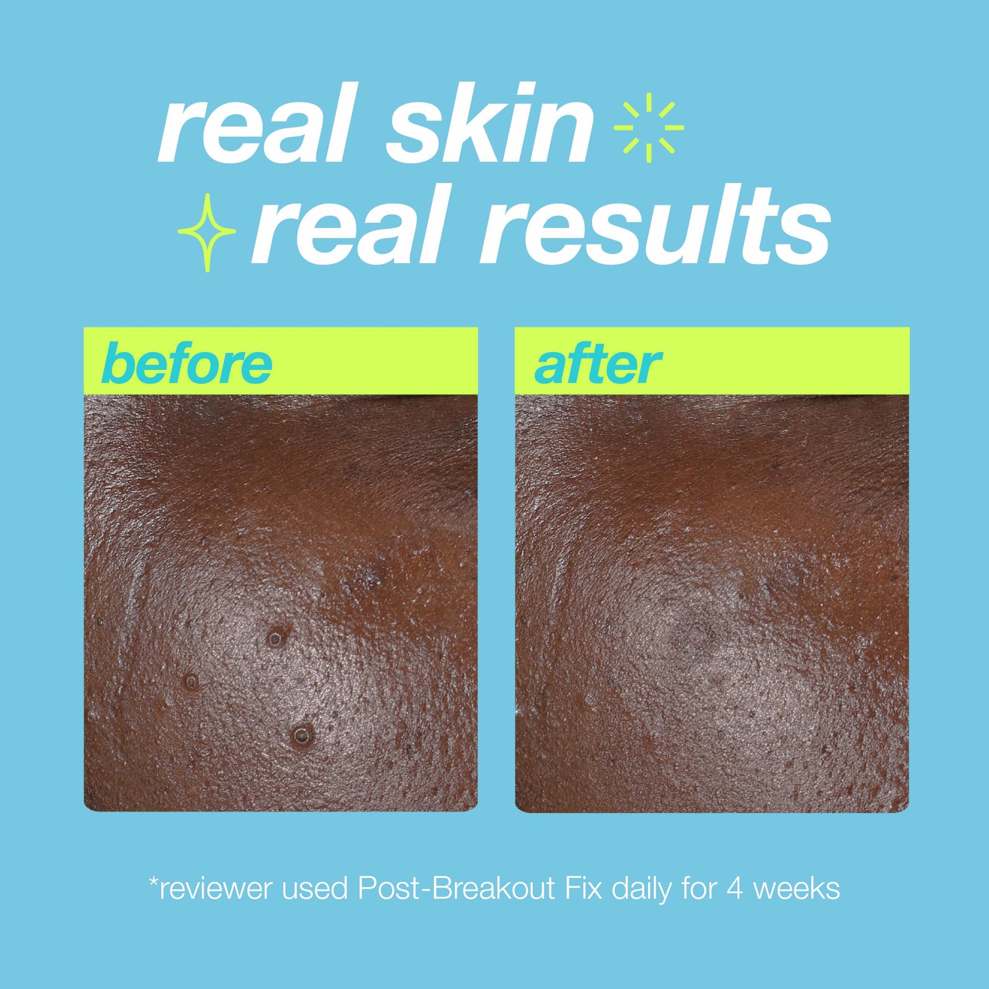 Sky Blue Dermalogica Clear Start Post-Breakout Fix, Acne Dark Spot Treatment with Salicylic Acid, Squalene & Hexylresorcinol, Fade + Brighten Acne Marks