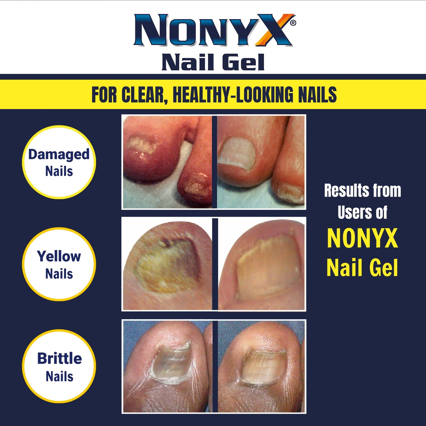 White Smoke NONYX Fungal Nail Clarifying Gel | Clinically Proven for Discolored, Thick, Brittle, Yellow, Lifted, and other signs of Fungus-Damaged Toenails | 90% of Nails Improve | Over 8 million sold